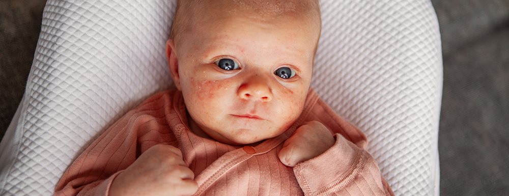 Akne kod beba: šta učiniti protiv toga prema riječima dječije dermatologinje