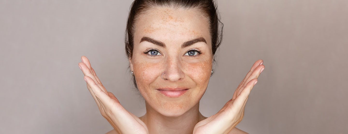 Ukloniti pigmentacijske mrlje: šta prema savjetu dermatologinje zaista pomaže