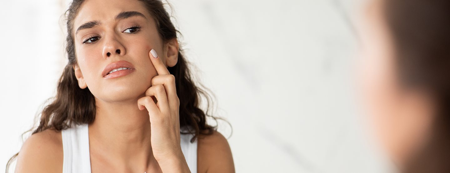 Hormonalne akne: dermatologinja objašnjava šta se može učiniti protiv njih