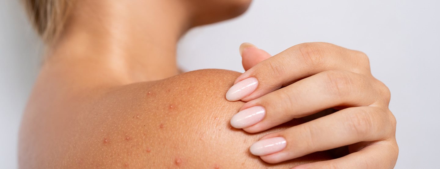 Razumjeti i spriječiti osip od vrućine: dermatologinja pojašnjava