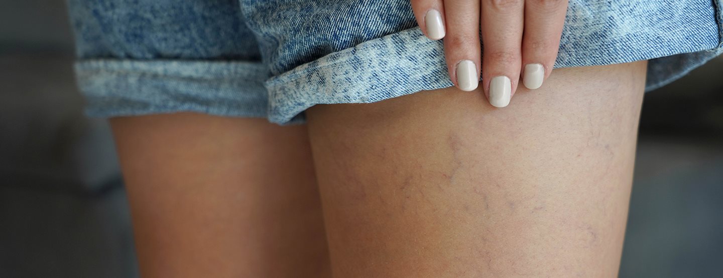 Uklanjanje kapilara: dermatologinja otkriva kako to postići!