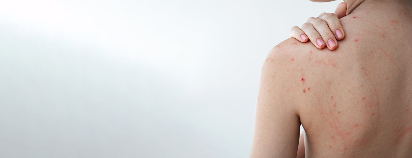 Bubuljice na leđima: prema dermatologinji, ovo uistinu pomaže protiv bubuljica na leđima