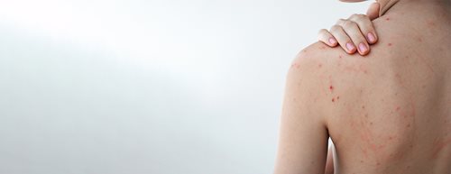Bubuljice na leđima: prema dermatologinji, ovo uistinu pomaže protiv bubuljica na leđima