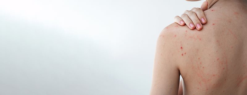 Bubuljice na leđima: prema dermatologinji, ovo uistinu pomaže protiv bubuljica na leđima